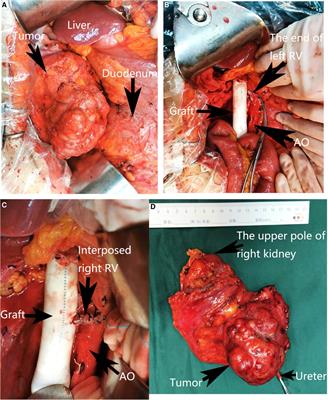 Case report: Reconstruction of the left renal vein with resected autologous right renal vein interposition after excision of an inferior vena cava leiomyosarcoma